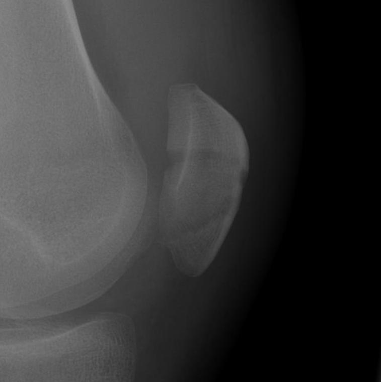 Undisplaced patella fracture